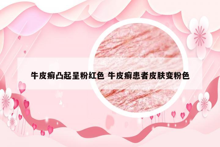 牛皮癣凸起呈粉红色 牛皮癣患者皮肤变粉色