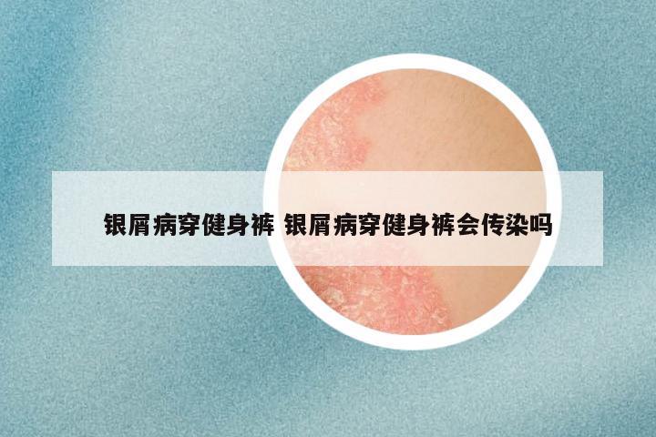 银屑病穿健身裤 银屑病穿健身裤会传染吗