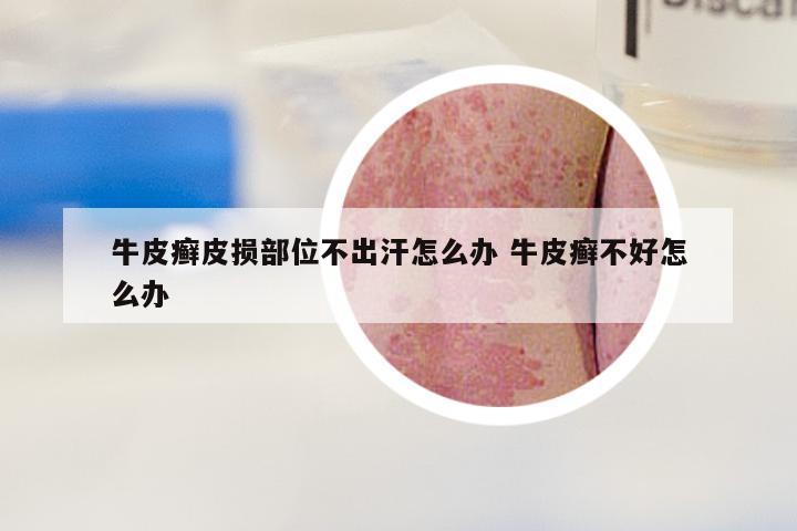 牛皮癣皮损部位不出汗怎么办 牛皮癣不好怎么办
