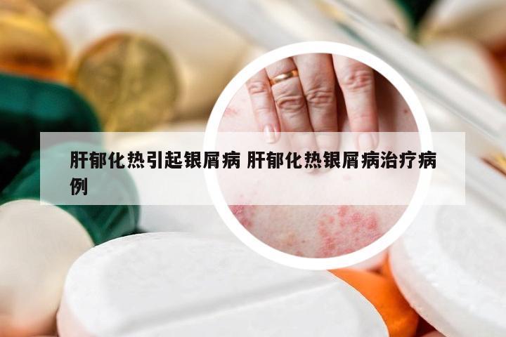 肝郁化热引起银屑病 肝郁化热银屑病治疗病例