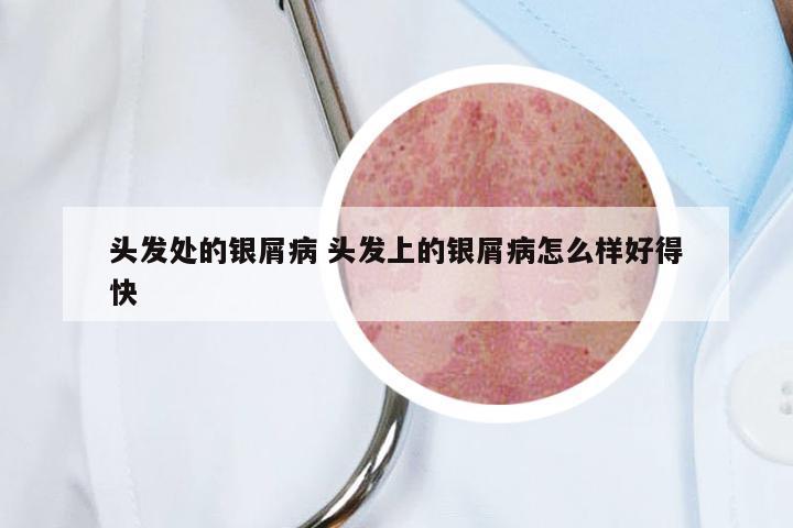 头发处的银屑病 头发上的银屑病怎么样好得快