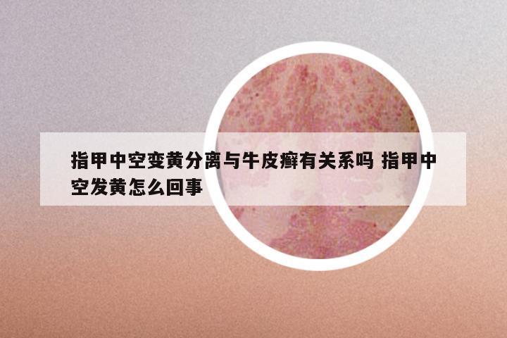 指甲中空变黄分离与牛皮癣有关系吗 指甲中空发黄怎么回事
