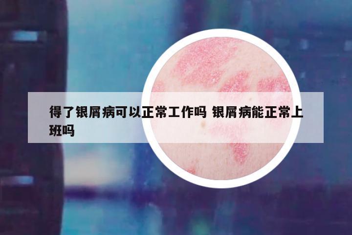 得了银屑病可以正常工作吗 银屑病能正常上班吗