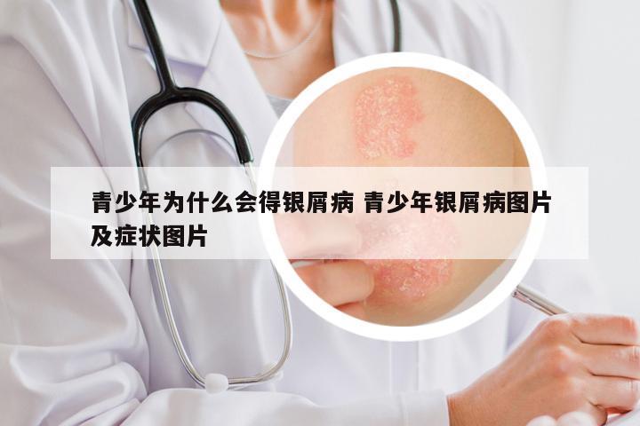 青少年为什么会得银屑病 青少年银屑病图片及症状图片