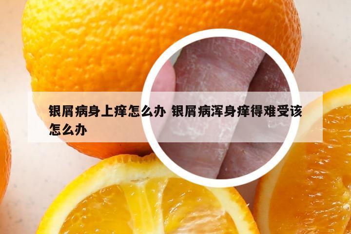 银屑病身上痒怎么办 银屑病浑身痒得难受该怎么办