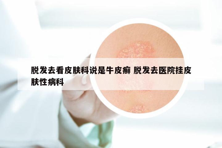 脱发去看皮肤科说是牛皮癣 脱发去医院挂皮肤性病科
