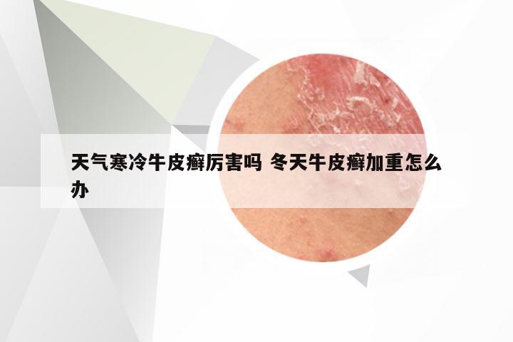 天气寒冷牛皮癣厉害吗 冬天牛皮癣加重怎么办