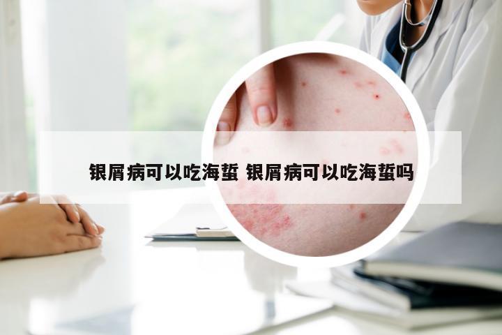 银屑病可以吃海蜇 银屑病可以吃海蜇吗