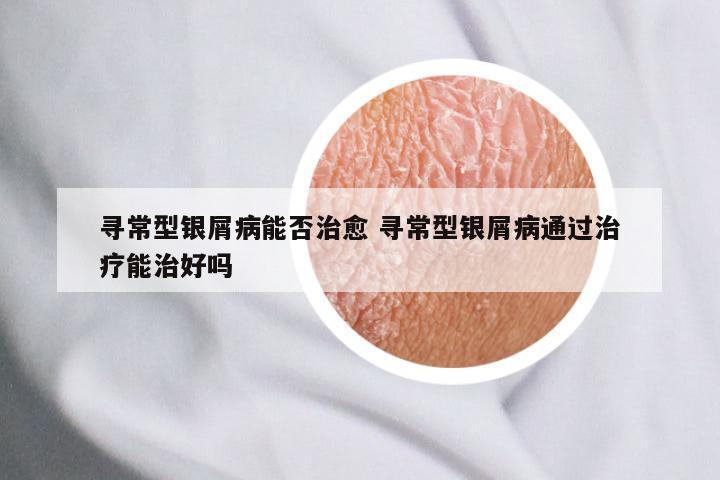 寻常型银屑病能否治愈 寻常型银屑病通过治疗能治好吗