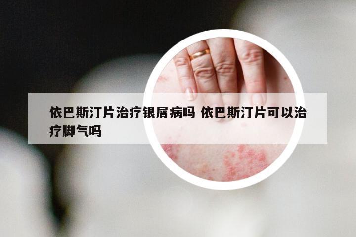 依巴斯汀片治疗银屑病吗 依巴斯汀片可以治疗脚气吗