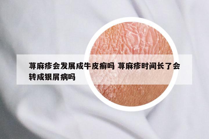 荨麻疹会发展成牛皮癣吗 荨麻疹时间长了会转成银屑病吗