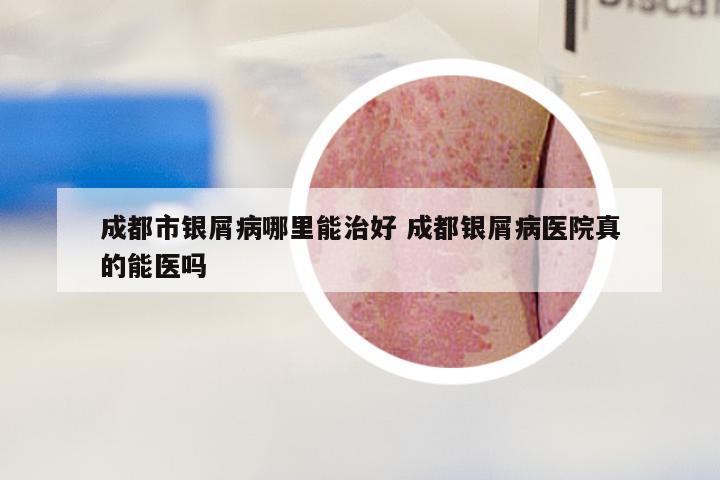 成都市银屑病哪里能治好 成都银屑病医院真的能医吗