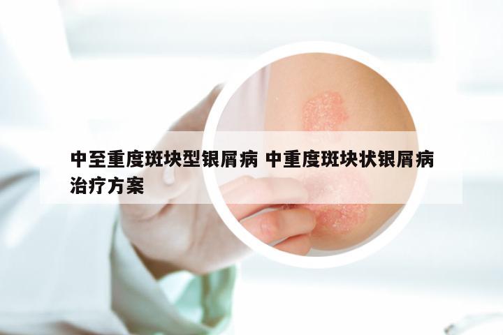 中至重度斑块型银屑病 中重度斑块状银屑病治疗方案