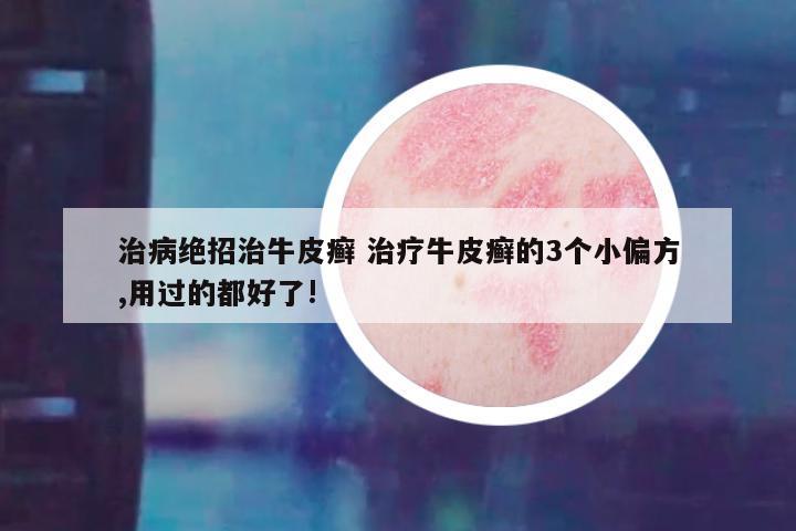 治病绝招治牛皮癣 治疗牛皮癣的3个小偏方,用过的都好了!