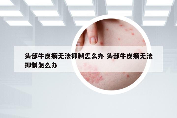 头部牛皮癣无法抑制怎么办 头部牛皮癣无法抑制怎么办