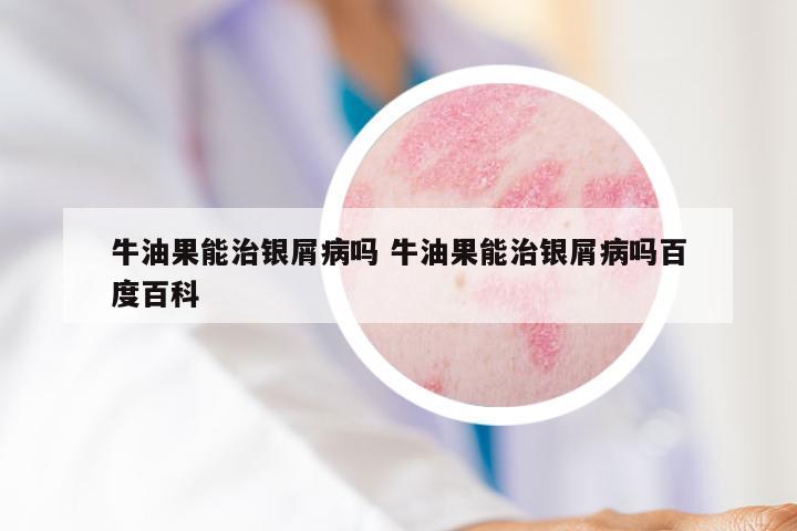 牛油果能治银屑病吗 牛油果能治银屑病吗百度百科