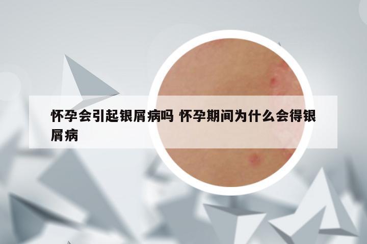 怀孕会引起银屑病吗 怀孕期间为什么会得银屑病