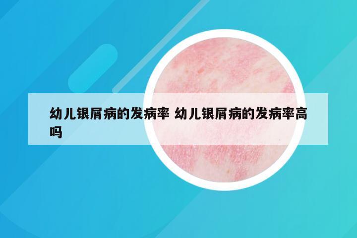 幼儿银屑病的发病率 幼儿银屑病的发病率高吗