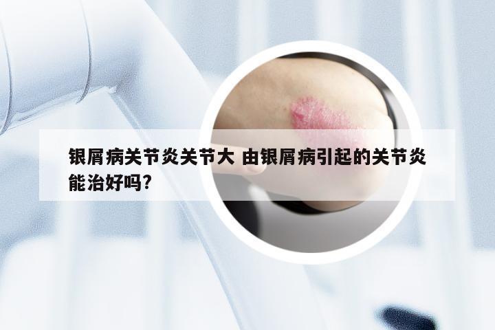 银屑病关节炎关节大 由银屑病引起的关节炎能治好吗?