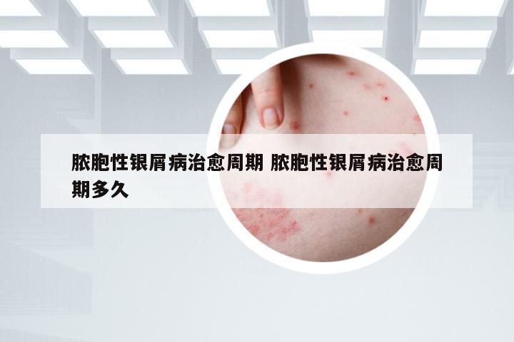 脓胞性银屑病治愈周期 脓胞性银屑病治愈周期多久