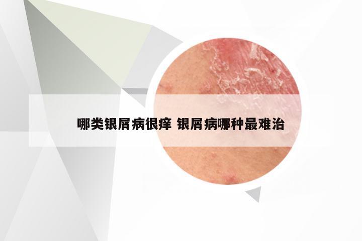 哪类银屑病很痒 银屑病哪种最难治