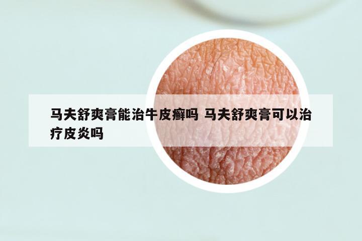 马夫舒爽膏能治牛皮癣吗 马夫舒爽膏可以治疗皮炎吗