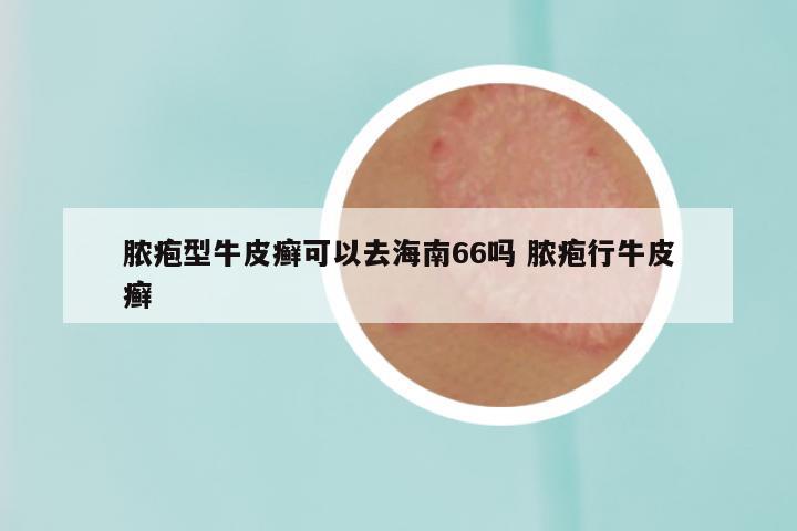 脓疱型牛皮癣可以去海南66吗 脓疱行牛皮癣
