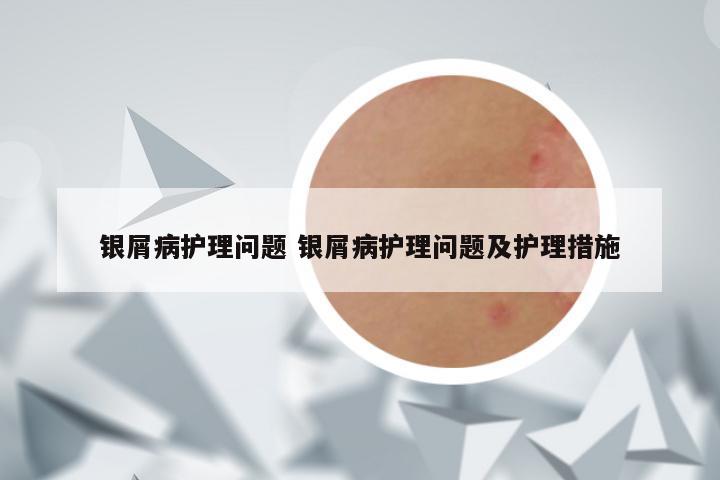 银屑病护理问题 银屑病护理问题及护理措施