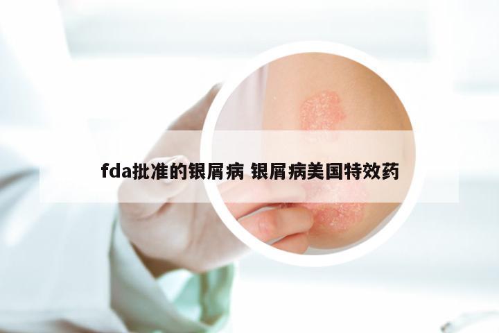fda批准的银屑病 银屑病美国特效药