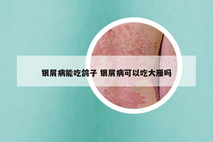 银屑病能吃鸽子 银屑病可以吃大雁吗