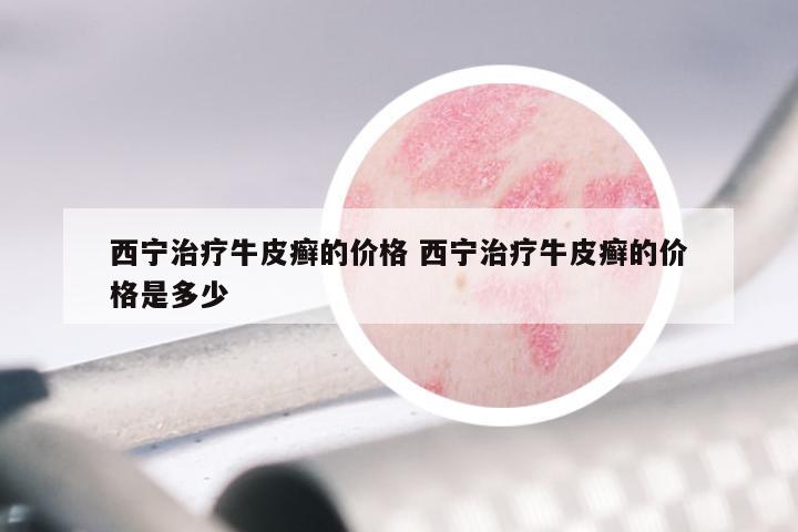 西宁治疗牛皮癣的价格 西宁治疗牛皮癣的价格是多少