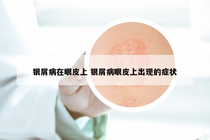 银屑病在眼皮上 银屑病眼皮上出现的症状