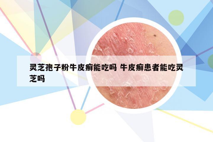 灵芝孢子粉牛皮癣能吃吗 牛皮癣患者能吃灵芝吗