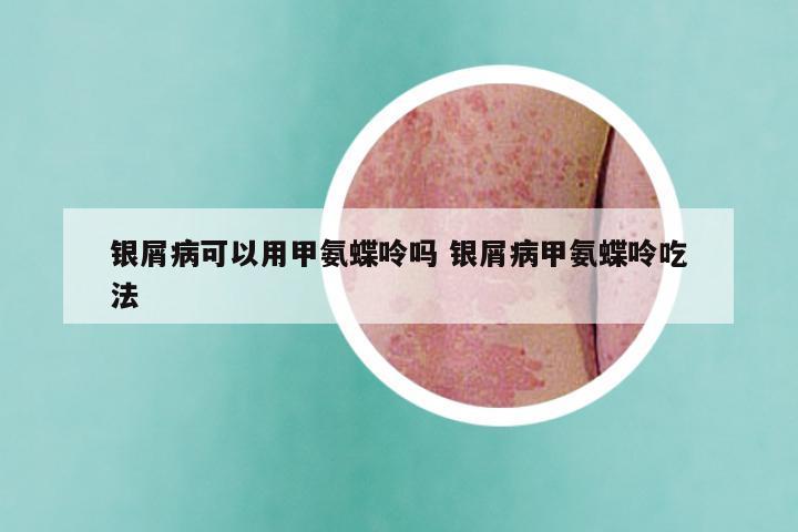 银屑病可以用甲氨蝶呤吗 银屑病甲氨蝶呤吃法