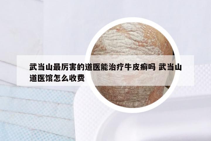 武当山最厉害的道医能治疗牛皮癣吗 武当山道医馆怎么收费