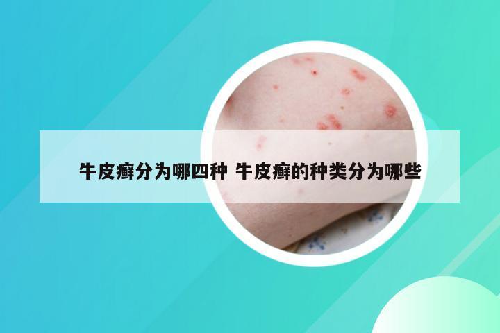 牛皮癣分为哪四种 牛皮癣的种类分为哪些