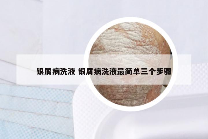 银屑病洗液 银屑病洗液最简单三个步骤