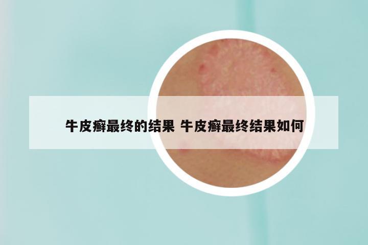 牛皮癣最终的结果 牛皮癣最终结果如何