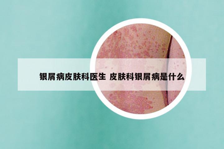 银屑病皮肤科医生 皮肤科银屑病是什么