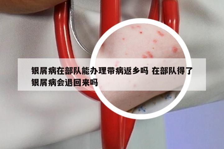 银屑病在部队能办理带病返乡吗 在部队得了银屑病会退回来吗