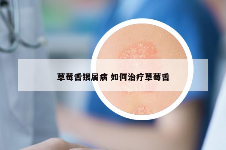 草莓舌银屑病 如何治疗草莓舌