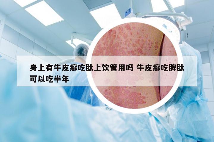 身上有牛皮癣吃肽上饮管用吗 牛皮癣吃脾肽可以吃半年