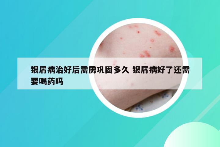 银屑病治好后需雳巩固多久 银屑病好了还需要喝药吗