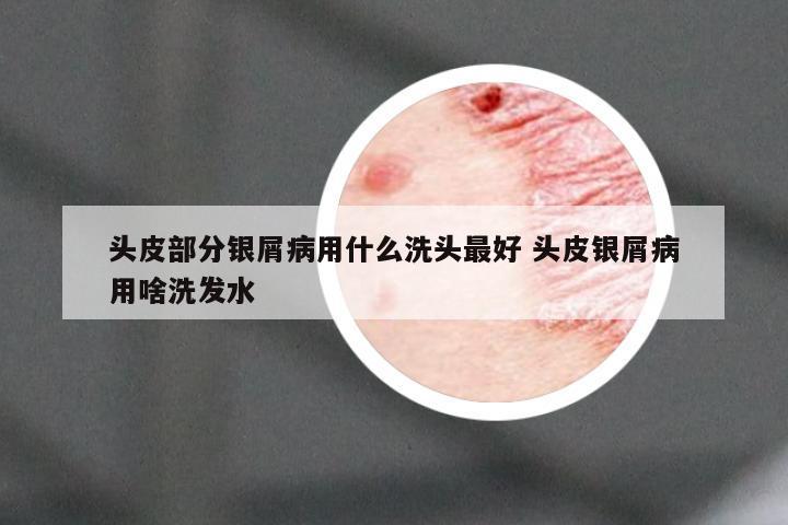 头皮部分银屑病用什么洗头最好 头皮银屑病用啥洗发水