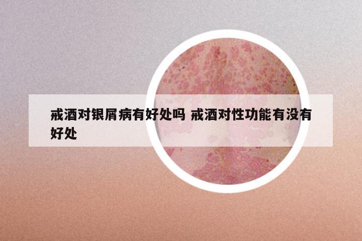 戒酒对银屑病有好处吗 戒酒对性功能有没有好处