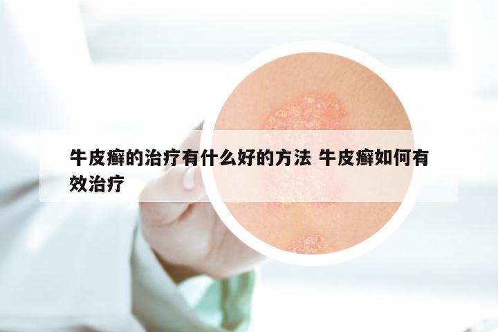 牛皮癣的治疗有什么好的方法 牛皮癣如何有效治疗