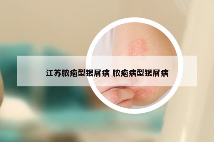 江苏脓疱型银屑病 脓疱病型银屑病