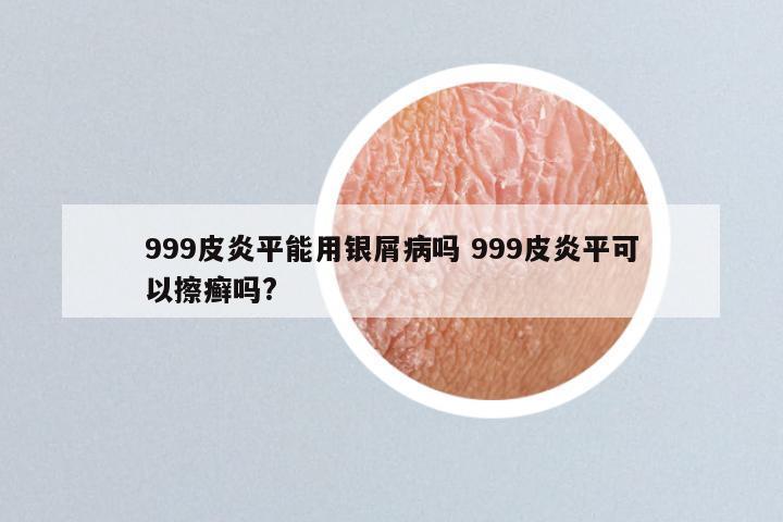 999皮炎平能用银屑病吗 999皮炎平可以擦癣吗?