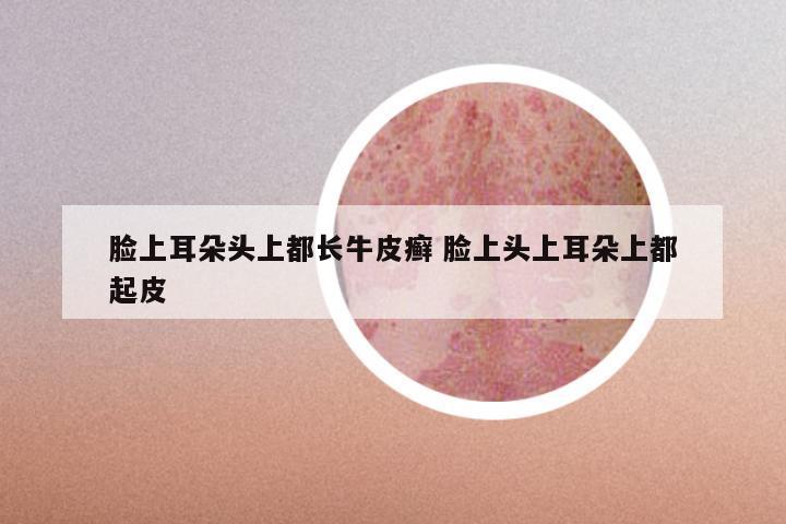 脸上耳朵头上都长牛皮癣 脸上头上耳朵上都起皮