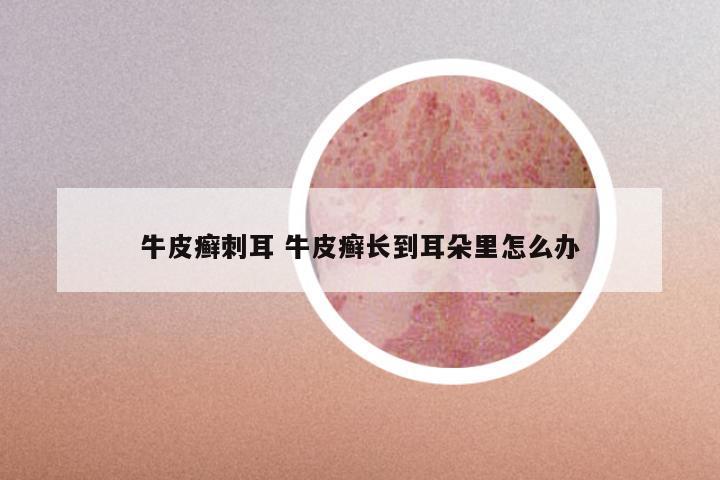 牛皮癣刺耳 牛皮癣长到耳朵里怎么办